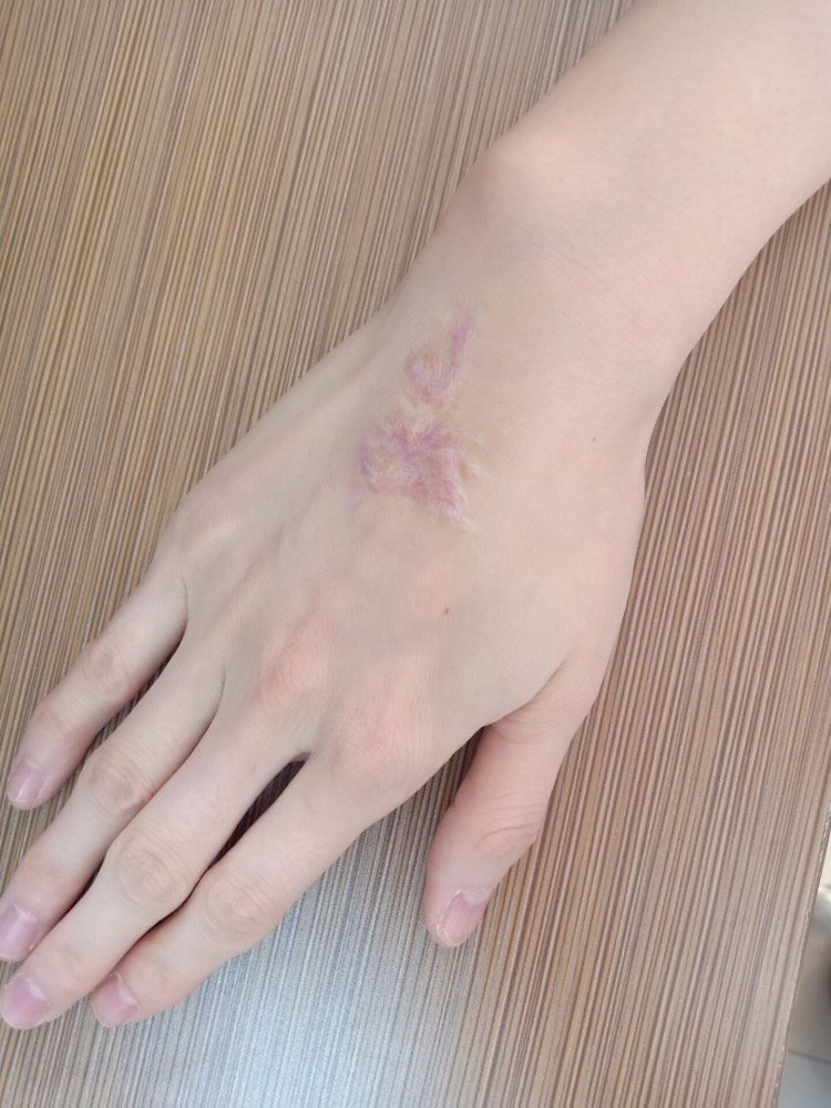 小时后跟着大爷家的哥哥放烟火烫伤的,他烫没了眉毛