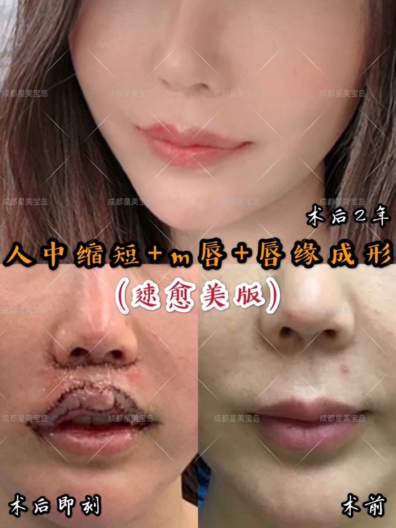 人中缩短是很多人都需要做的项目,但也是疤痕最明显的项目,我们多年