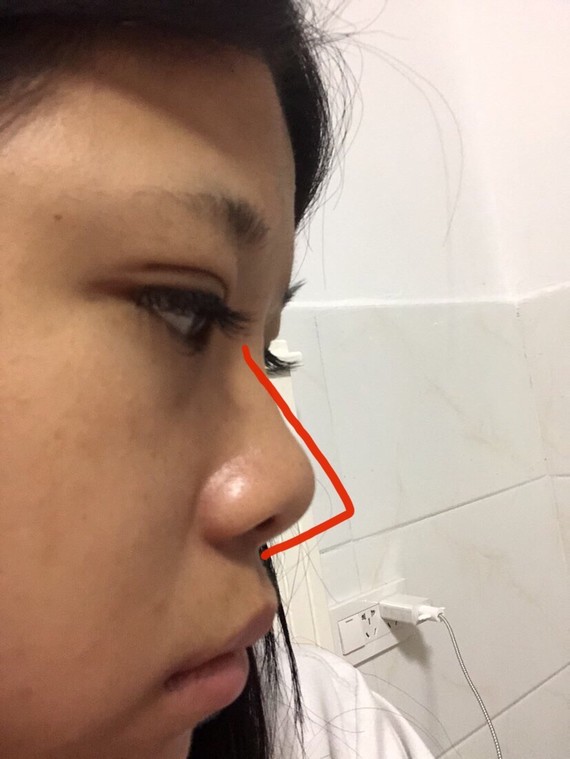 肉肉的感觉7215鼻部多项项目:假体垫高 鼻中隔延长 鼻小柱抬高