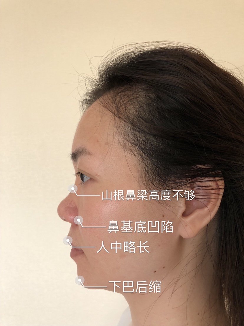 您好发际线后移太阳穴凹陷山根低蒜头鼻双下巴建议微整穿搭化妆发型