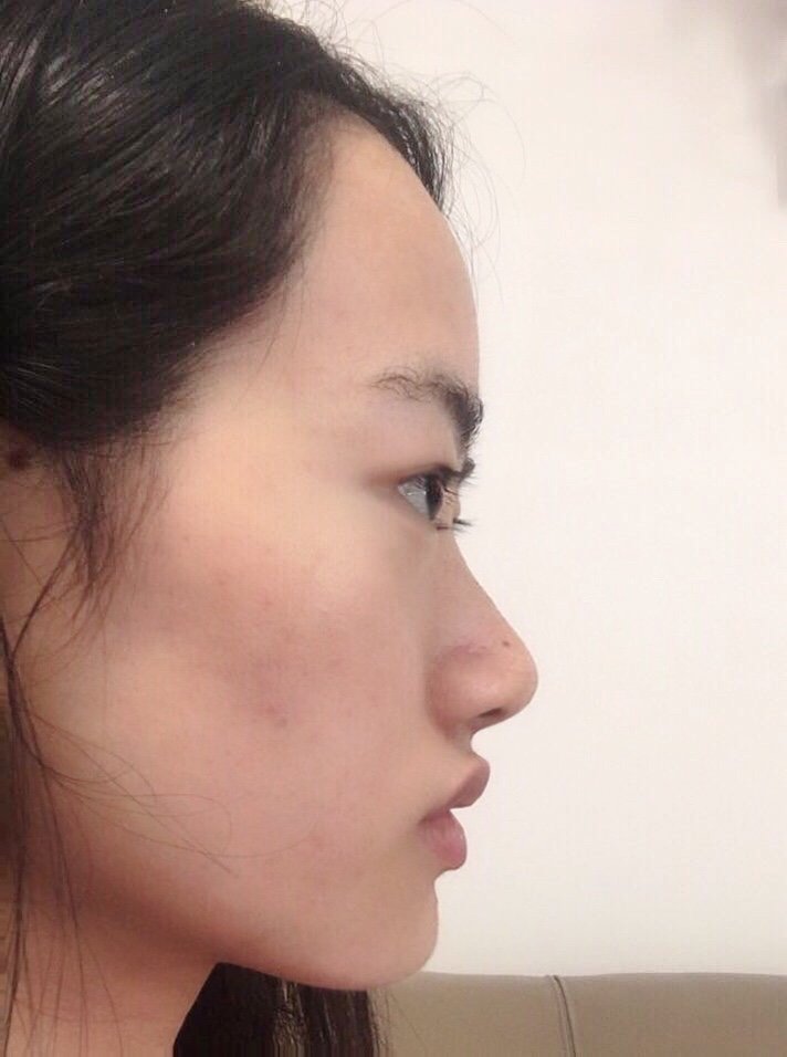 不喜勿喷很想整成半藏森林的纯欲风嘴唇太厚肿眼泡大鼻头的我该咋整