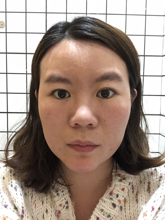 求看脸求看脸:头扁国字脸,面塌又凸嘴,能整成鞠婧伟_圈子-新氧美容