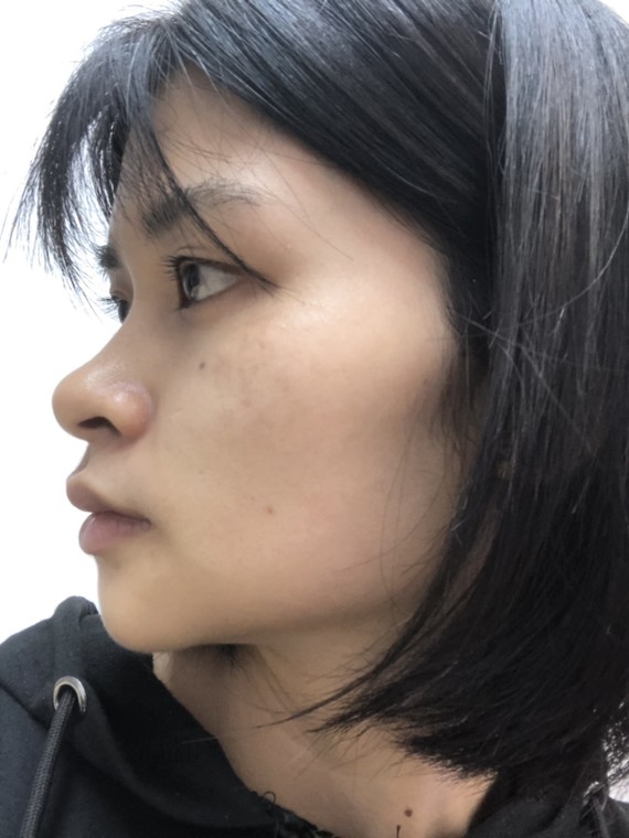 尖头,太阳穴凹陷,颧弓外扩,脸颊凹陷,大小脸,凸嘴等等,唉……问题实在