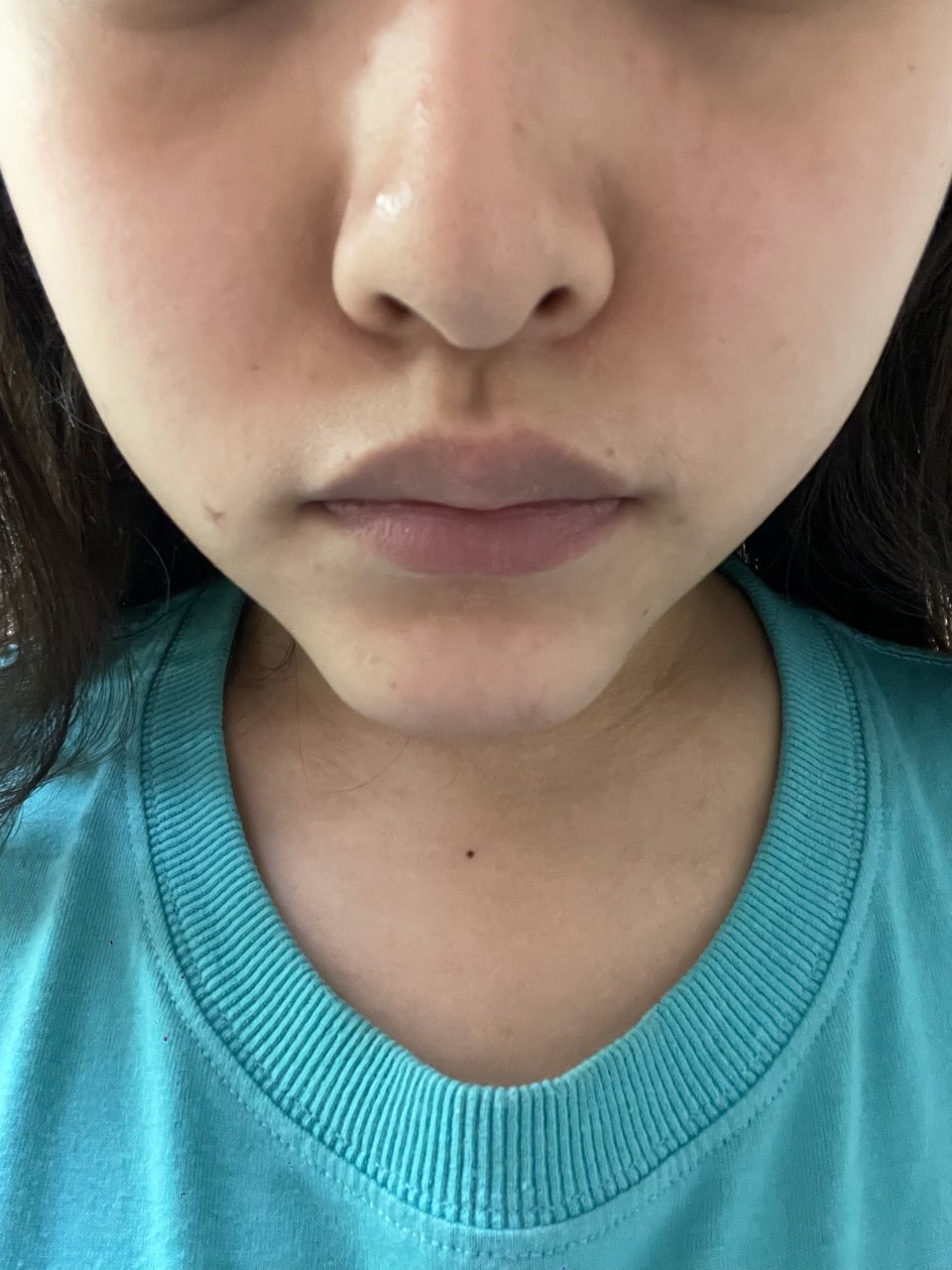 假体下巴衔接问题