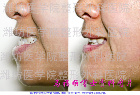 小反颌畸形手术前后对比照片反颌畸形一般是指下颌骨过_圈子-新氧美容