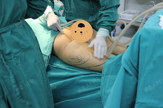 这次手术一共有三个部位要抽脂,何主任安排的次序是,先抽大腿,再到
