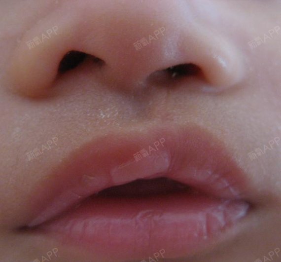 初生婴儿隐形唇裂图片图片