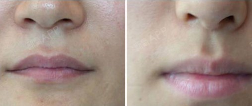 (修复单侧唇裂的方法)及口轮匝肌(口唇内环绕口裂的环形肌)功能性修复