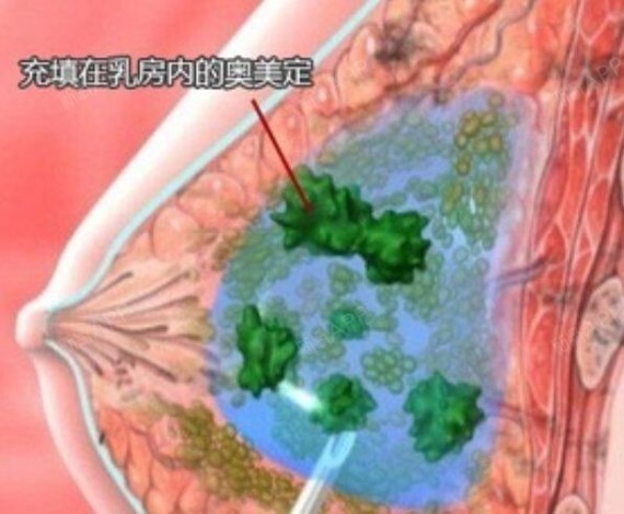 女子丰胸十年,胸跑后背【教你鉴别危害的整形材料】