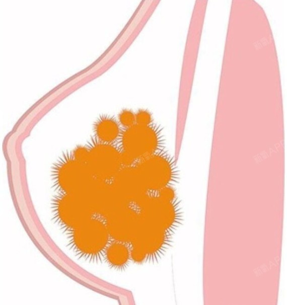 丰胸坏处图片