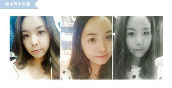 瑞娜的服务很好有专门的术后管理系统哦这样就顺便做了排毒和美容养颜