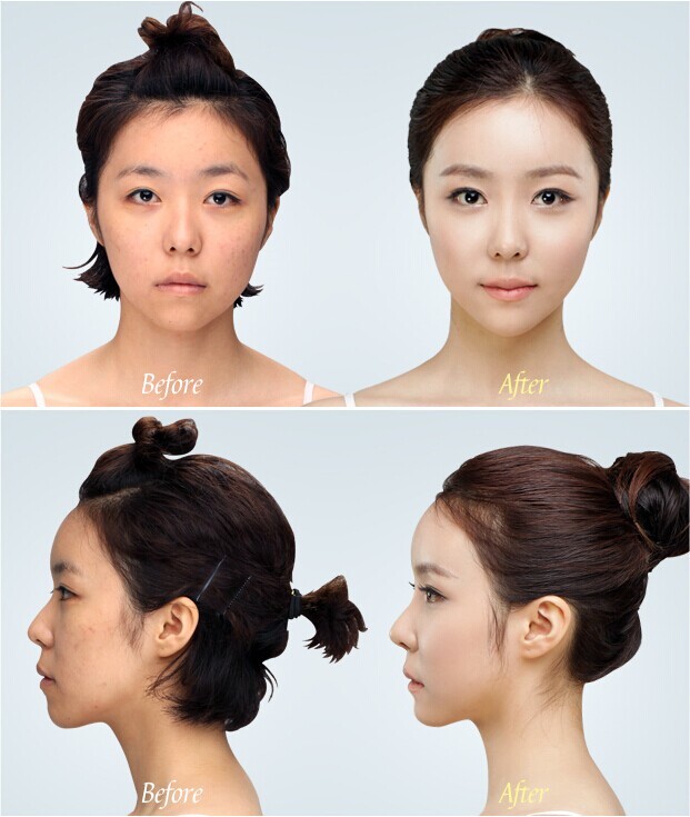 【面部轮廓】颧骨颧弓整形术