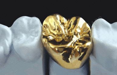 【韩国多仁牙科医院】谁说黄金冠丑~ (牙冠种类有哪些)