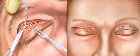 【韩国眼部整形(眼睑下垂与眼型矫正术)手术方法】