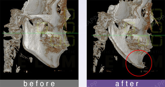 【jelim整形外科-楊丁學院長的整形說】無下巴矯正手術後記