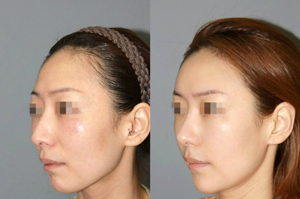 韩国隆鼻手术是采用韩国三段式假体精细塑造完美鼻形,隆高鼻梁,缩小