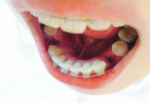 新氧- piano(漂牙)牙科 | 术后当自强 | 牙齿畸形 | 牙齿 | 免费整形