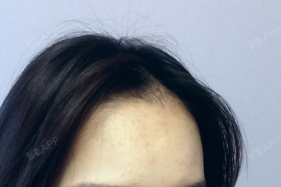 做了发际线 在额头前移植了一些小碎发 ,快3个月了