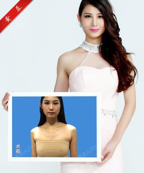 隆胸整形手术进行中