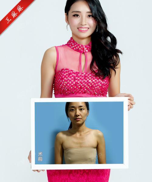 王琳琳--5a艺术全胸美塑科技对比