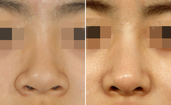 无痕鼻翼缩小