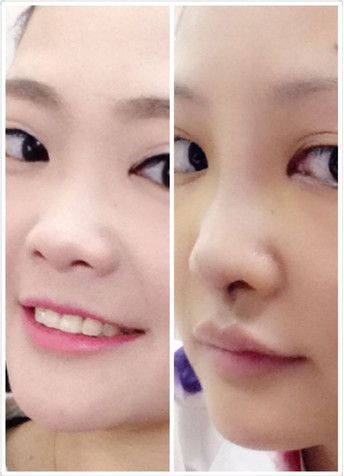 合集·自体软骨垫鼻尖