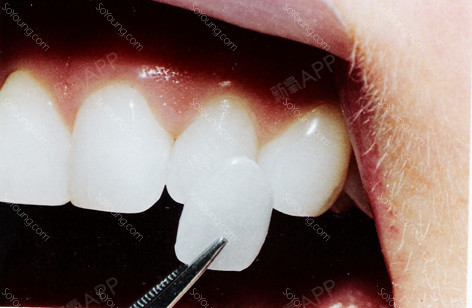 优惠活动,许多海外患者来访问具有韩国先进医疗技术的韩国漂牙牙科