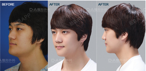 男士整形(两颚 缩小鼻翼)真实案例