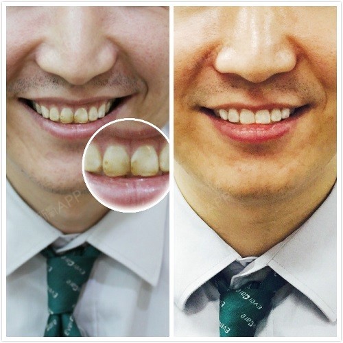 (上图)牙齿恢复自然白   再给大家来张前后对比图看一下