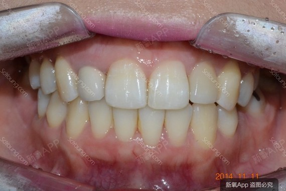 现存装置的短处是有异物感,漂牙牙科所使用的矫正托槽是最新改进版