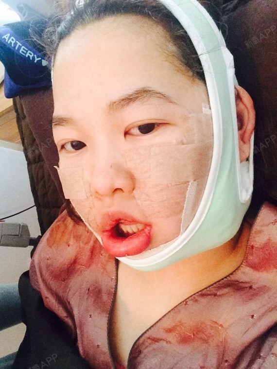 术后day1    嘴巴里面开始肿起来