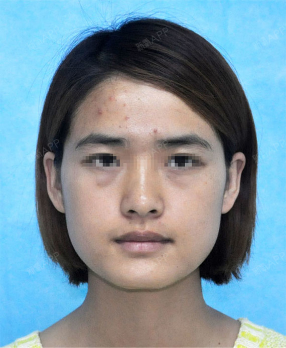 先看看术前的照片,下颌角反打比较突出,建议下颌骨长曲线截骨