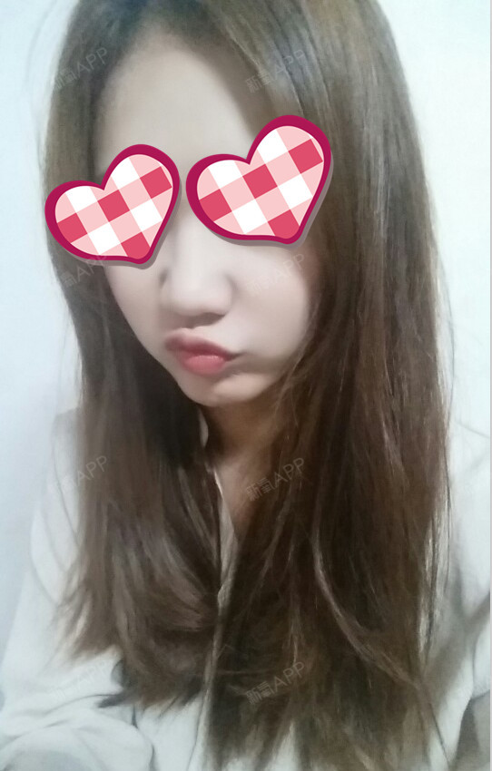 【韩国那木整形医院】圆头鼻手术真实案例!