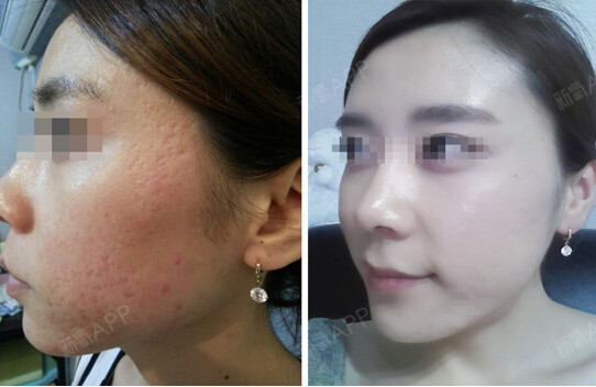 答:青春痘留下的凹陷痘痕 水痘留下的凹陷痘痕 ,凹陷疤痕,塌陷疤痕