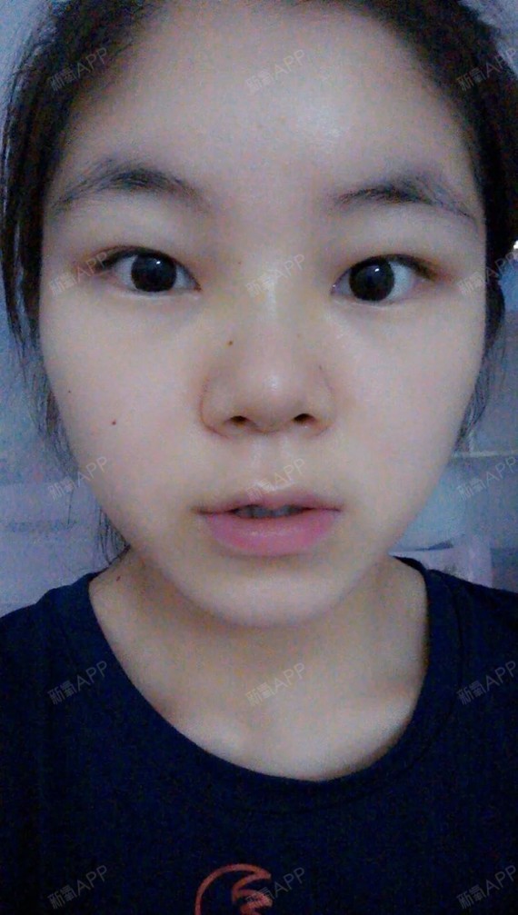 【免费活动】【北京杨仁宝医生免费双眼皮手术】眼睛大_圈子-新氧美容