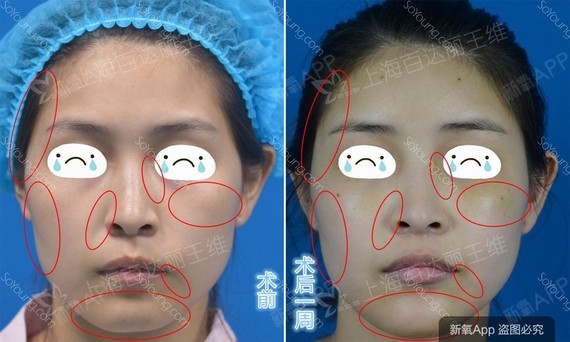 【面部年轻化案例】告别三八线,拒做黄脸婆,告诉你如何保持童颜