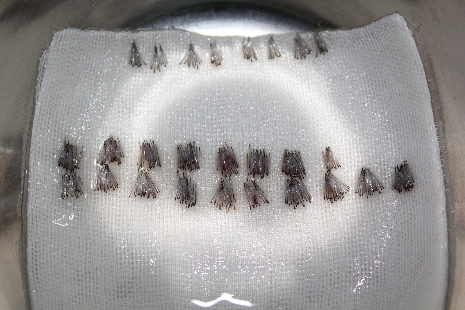 5月份,我下定决心去植发了,大家有什么想问的吗?