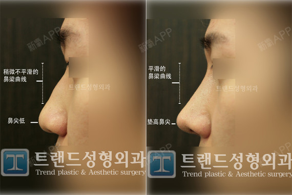 较严重的福鼻案例