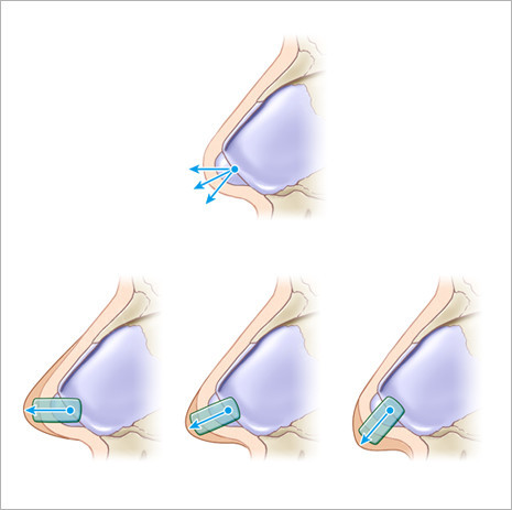 鼻中隔延长介绍