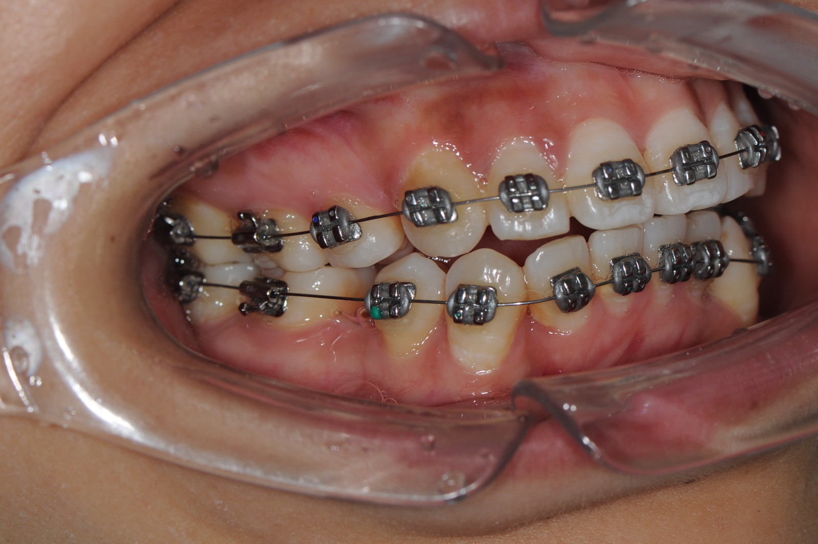 与大家分享一下我这种比较复杂牙齿的矫正过程,说实话我之前并不觉得