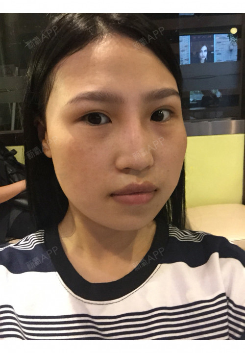 瘦脸针太方便了!困扰杨女士二十年的大脸一针解决