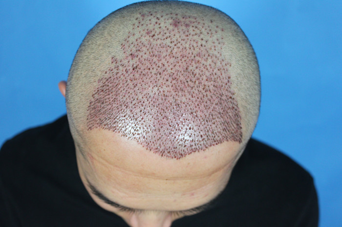 新氧- 新发现植发 | 术后当自强 | 毛囊单位移植 | 毛发 | 毛发移植