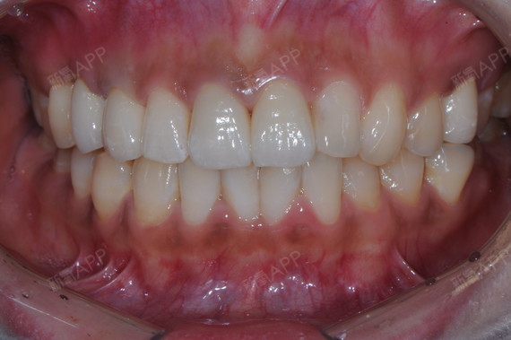 今天与大家分享一个全瓷牙的案例,如果您口内有镶过牙_圈子-新氧美容