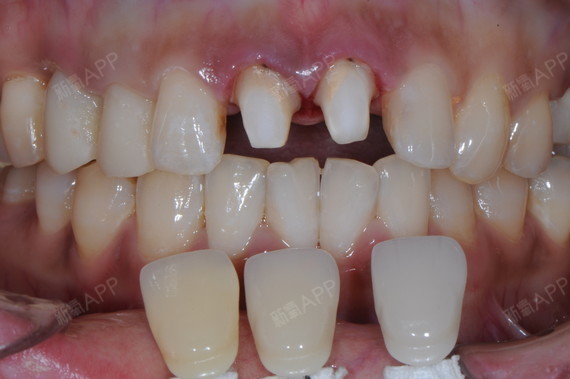 今天与大家分享一个全瓷牙的案例,如果您口内有镶过牙_圈子-新氧美容