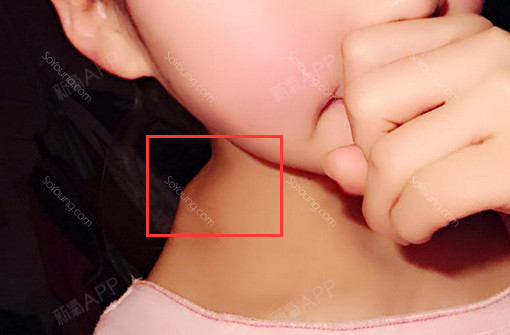 2015年10月 0 losecontrol 我的下颌骨宽,这样