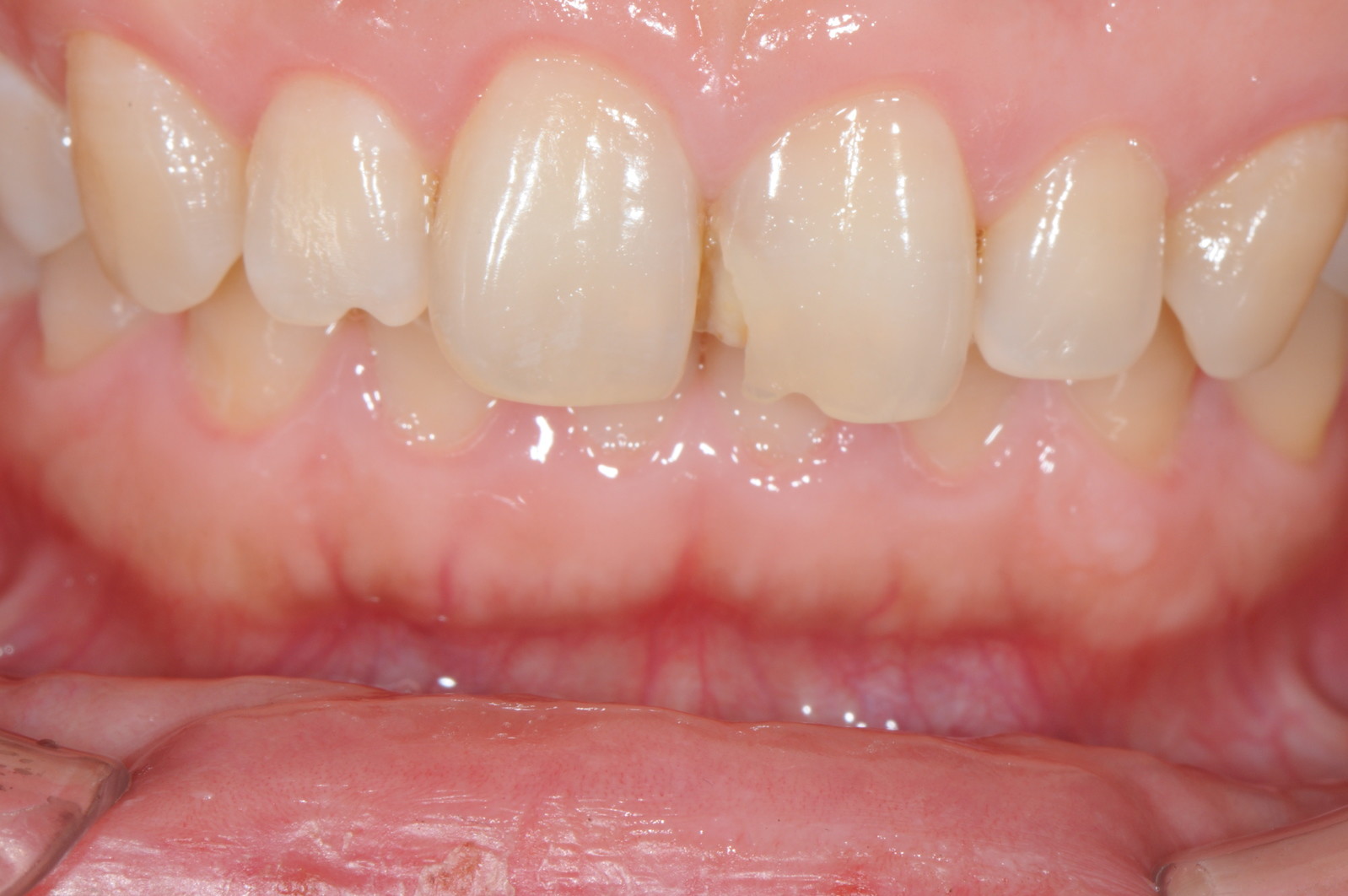 这是一位26岁的美女,之前牙齿龋坏,补过后由于吃东西蹦掉了.