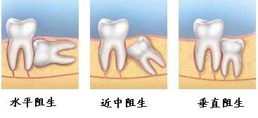 智齒是指人類口腔內,牙槽骨上最裡面的上下左右各一的四顆第三