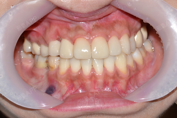 去年10月份下颚右侧做了种植牙,同时也拔了虎牙,拔_圈子-新氧美容整形