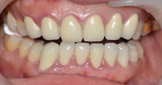 5年前做的烤瓷牙,牙龈变色,颜色看起来发闷,不透,_圈子-新氧美容整形