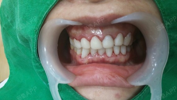 5年前做的烤瓷牙,牙龈变色,颜色看起来发闷,不透,_圈子-新氧美容整形